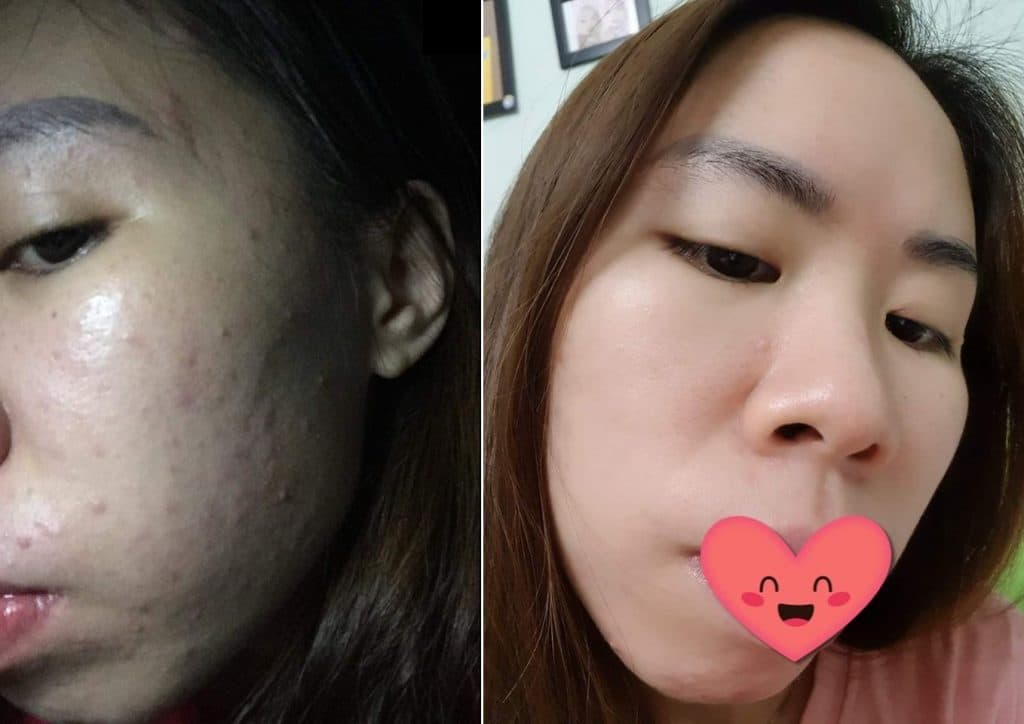 Khách hàng trước và sau khi sử dụng serum trị mụn trắng da Doctor OZ
